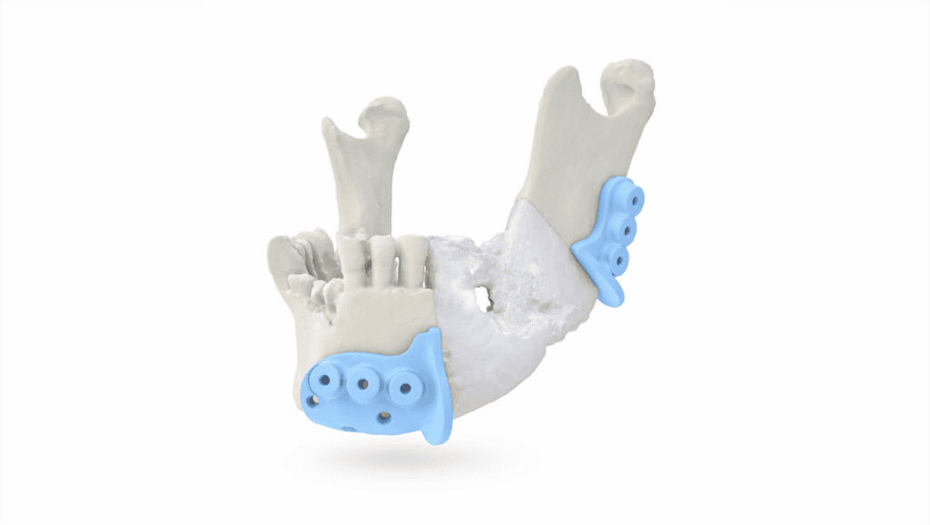 Mandible reconstruction model using fibula free flap for jaw repair.