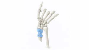 3D model of Madelung’s deformity affecting the wrist bones.