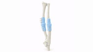 Pediatric ulna and radius bones with surgical fixation for malunion correction.