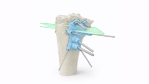 Surgical model of anterior closing wedge high tibial osteotomy for knee correction.