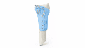 Articular distal radius malunion guide used in orthopedic surgery for precise realignment.