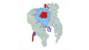Surgical model of left iliac pelvic resection showing detailed anatomy and surgical approach.