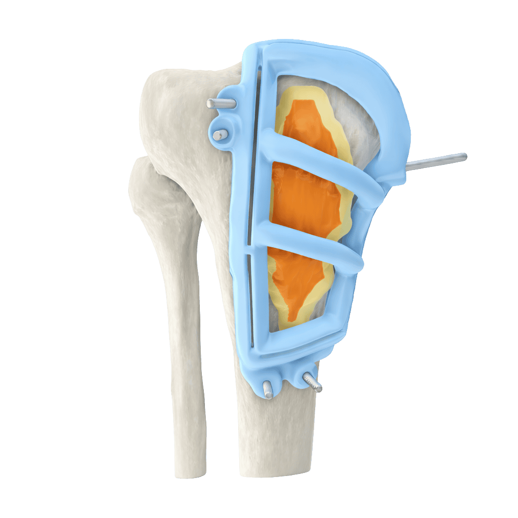 Knee joint with surgical implant and medical device for knee replacement.