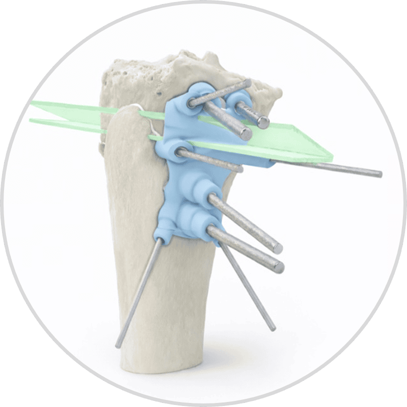 Minimally invasive orthopedic surgery with advanced implant technology.
