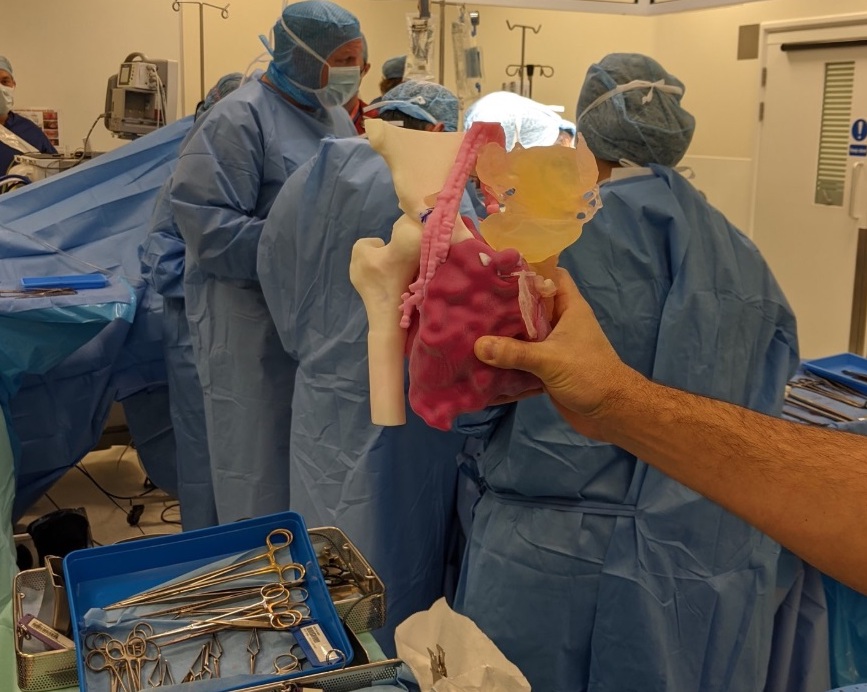 A 3D printed model of a pelvic/sacral tumor is held up while surgeons carry out a resection procedure in the background.